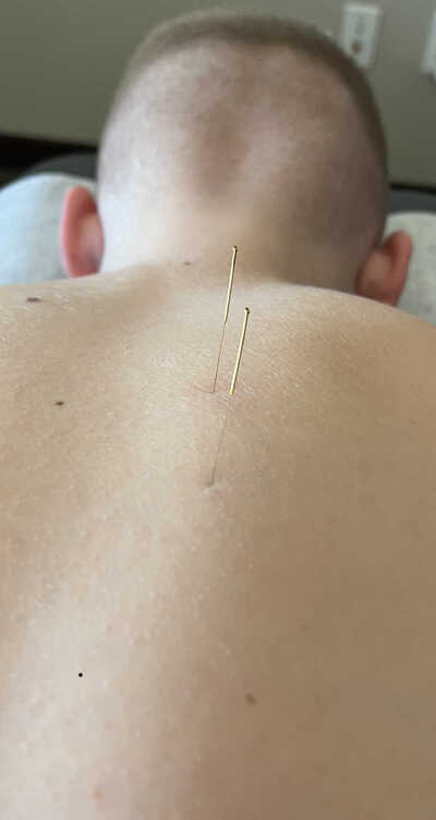 Patient given Acupuncture