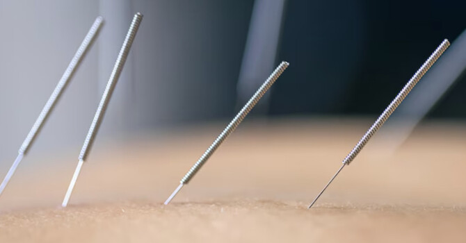 Dry Needling vs. Acupuncture: Understanding the Key Differences image