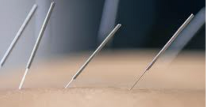 What Is Dry Needling and How Does It Help?
